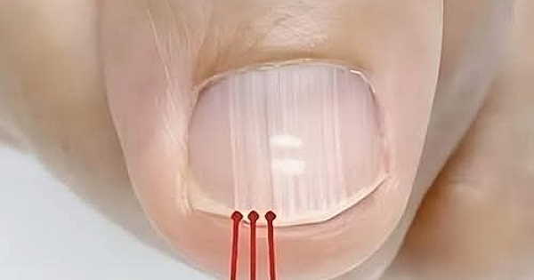 40 Yaşından Sonra Tırnağınızda Bu Çizgiler Varsa 