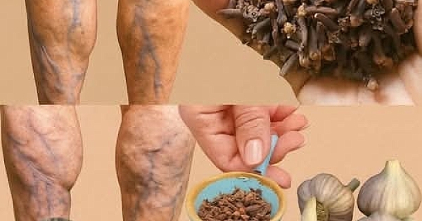 Bacak ağrısı, romatizma, varis, artrit 