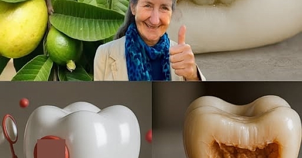 Diş Çürüğünü Tedavi Etmenin En İyi 3 Yolu 