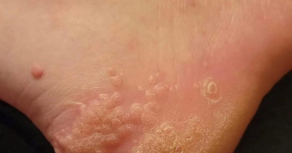 Kullanılmış ayakkabı Giymenin Sonuçu 