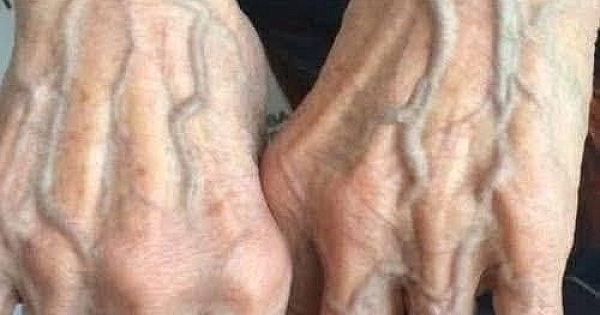 Görünür damarların varsa 