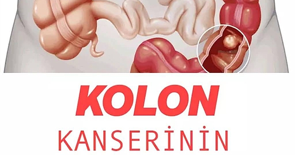 Kolon Kanserinin 5 Belirtisi 