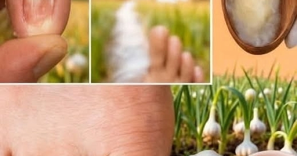 Tırnak mantarı ve aşırı terleme 