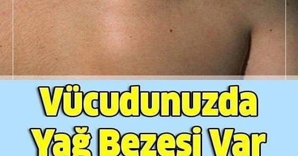 Vücudunuzda Yağ Bezesi Var İse 