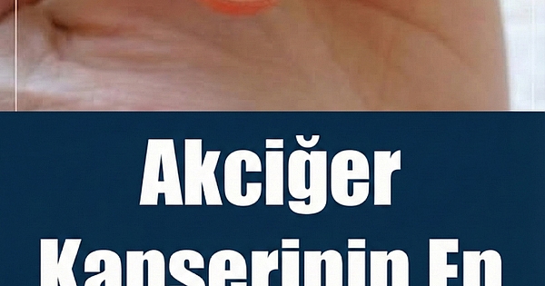 Akciğer Kanserinin En Sinsi 9 Belirtisi 