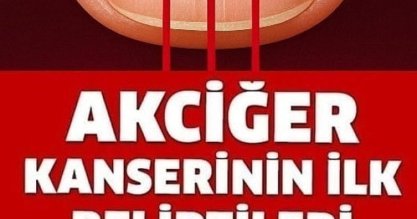 Akciğer Kanserinin En Sinsi 9 Belirtisi 
