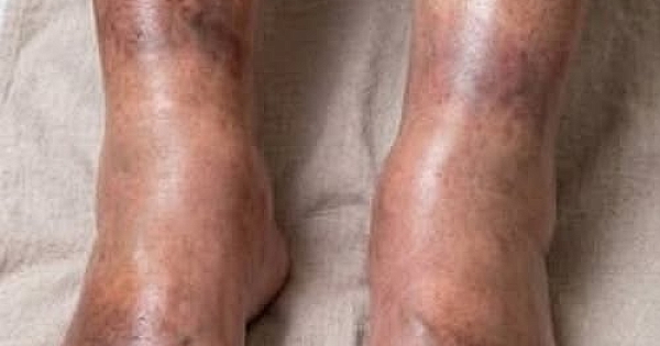 Sessiz sinyal Şişmiş bacaklar 