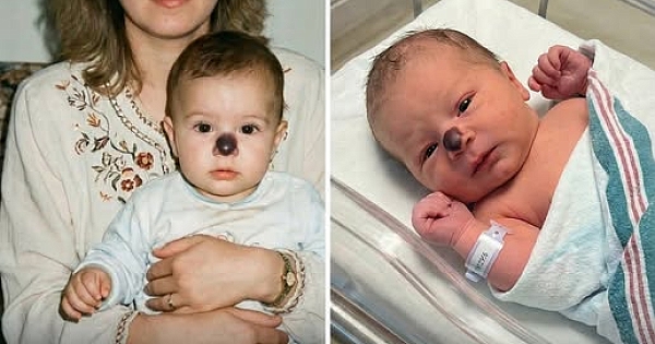 Torunumun Burnundaki doğum lekesi 