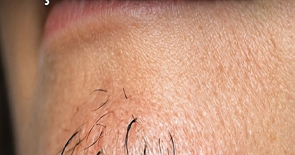 Kadınlarda Çene Kıllarının Büyümesi 