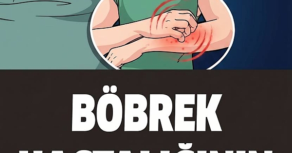 Böbrek Yetmezliğinin 13 Erken Belirtisi! Sessiz İlerliyor 
