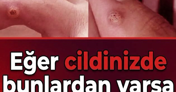 İşte Tedavisi.. 