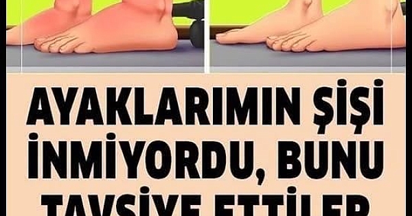 Ayaklarımın Şişi bir türlü İnmiyordu
