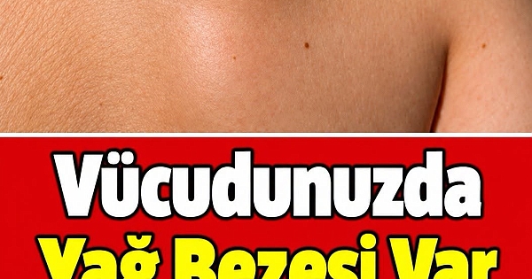 Vücudunuzda Yağ Bezesi Varsa