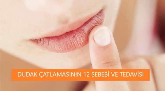 Dudak Çatlamasının 12 Sebebi Nedir? Çatlak Dudak Bakımı için Neler Önerilir?