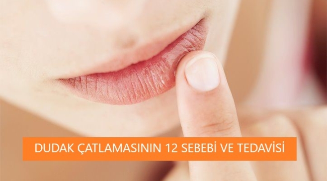 Dudak Çatlamasının 12 Sebebi Nedir? Çatlak Dudak Bakımı için Neler Önerilir?