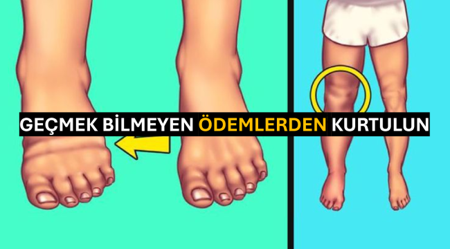 Geçmek Bilmeyen Ödemlerden Kurtulun