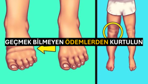 Geçmek Bilmeyen Ödemlerden Kurtulun