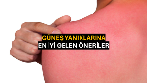 Güneş Yanıklarına En İyi Gelen Öneriler