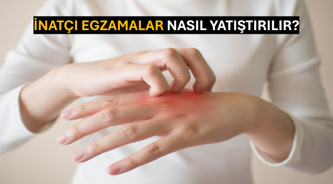 İnatçı Egzamalar Nasıl Yatıştırılır?