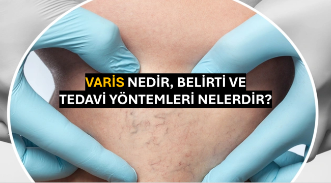 Varis Nedir, Belirti ve Tedavi Yöntemleri Nelerdir?