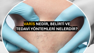 Varis Nedir, Belirti ve Tedavi Yöntemleri Nelerdir?