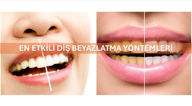 En Etkili Diş Beyazlatma Yöntemleri