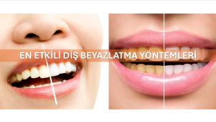 En Etkili Diş Beyazlatma Yöntemleri